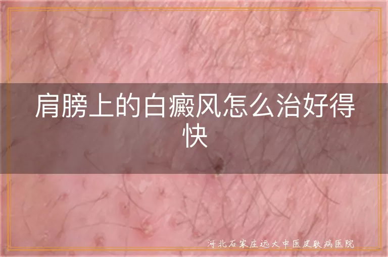 白癜风,肩膀,一般治疗,药物治疗,光疗,手术治疗,中医治疗,心态平和