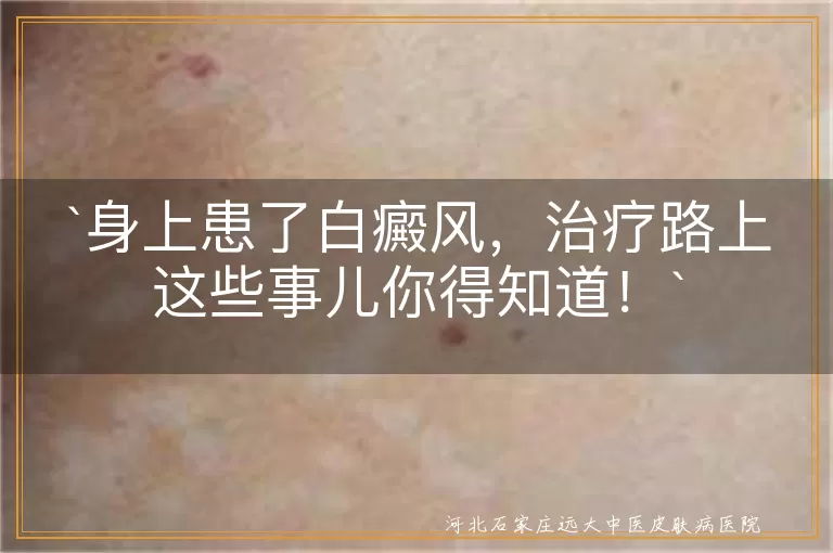白癜风,治疗,药物治疗,光疗,手术治疗,中医治疗,注意事项,误区