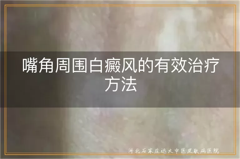 白癜风,嘴角周围,治疗方法,药物治疗,物理治疗,手术治疗,心态调整,生活习惯