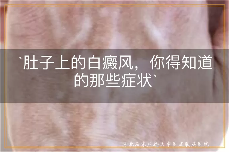 肚子上白癜风,白斑,症状,变化,瘙痒,扩散