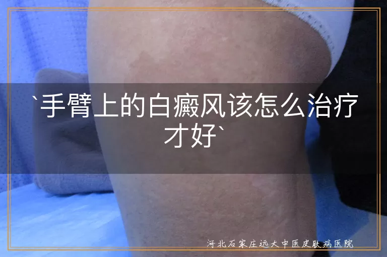 手臂上的白癜风该怎么治疗才好