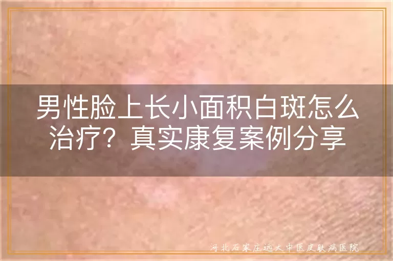 男性脸上长小面积白斑怎么治疗？真实康复案例分享