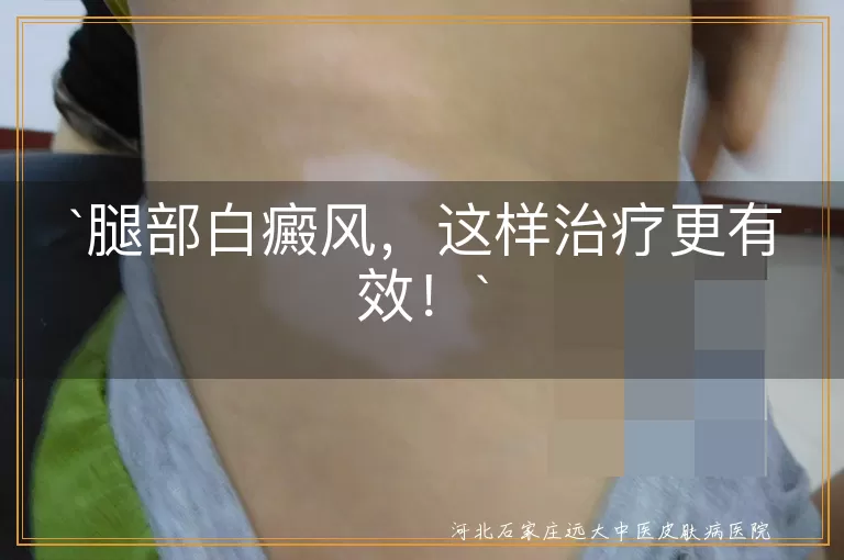 腿部白癜风,治疗,黑色素细胞,药物治疗,光疗,手术治疗,中医治疗,心理治疗,生活调理