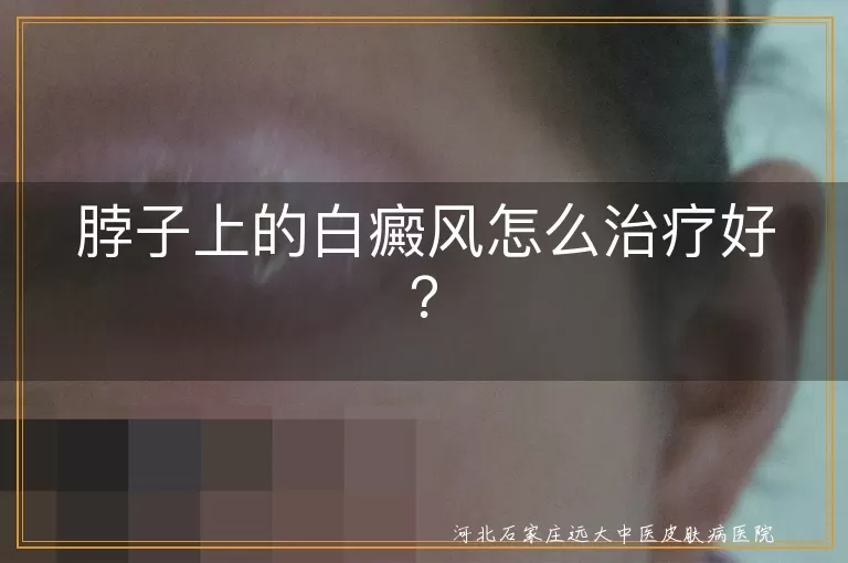 白癜风,脖子,治疗,防晒,药物,光疗,手术,心理治疗
