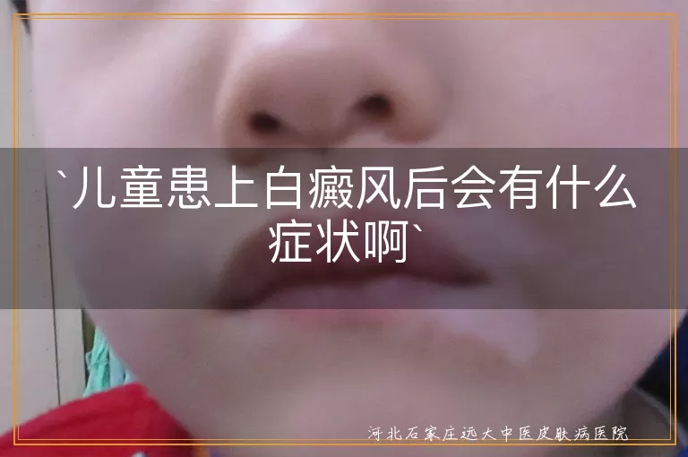儿童白癜风,白斑,皮肤敏感,心理健康,及时就医