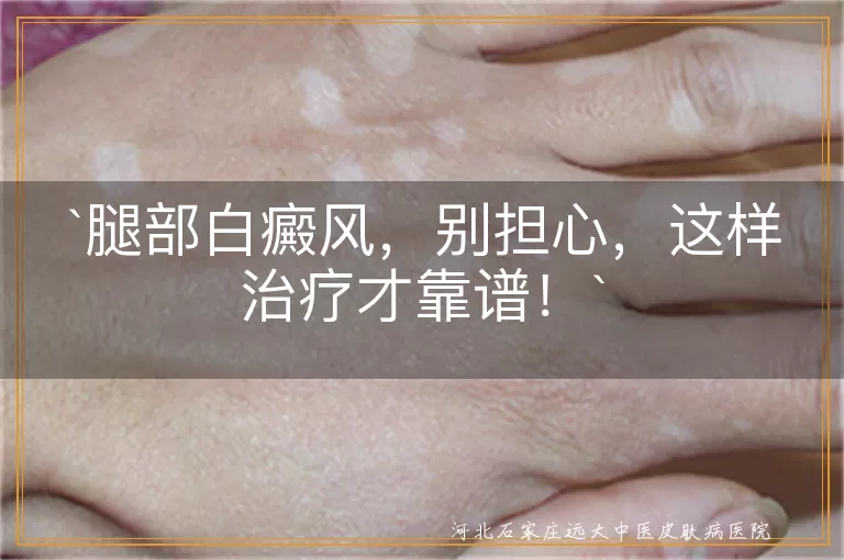 腿部白癜风,治疗,药物治疗,光疗,手术治疗,中医治疗,注意事项