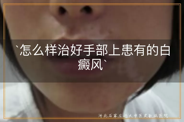 怎么样治好手部上患有的白癜风