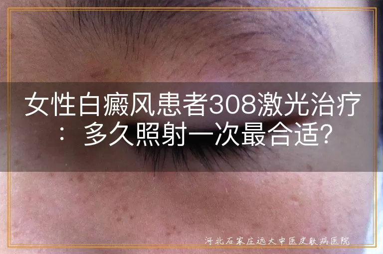 女性白癜风患者308激光治疗：多久照射一次最合适？