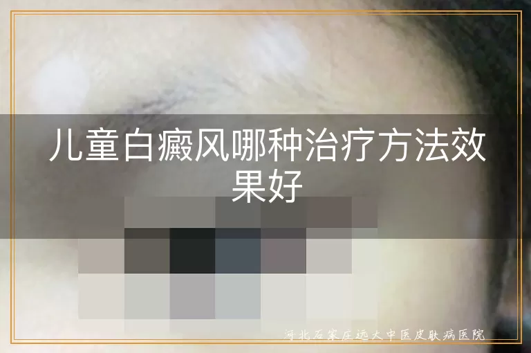 儿童白癜风哪种治疗方法效果好