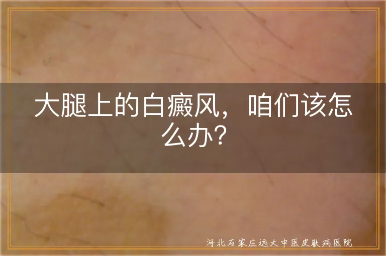 大腿上的白癜风，咱们该怎么办？