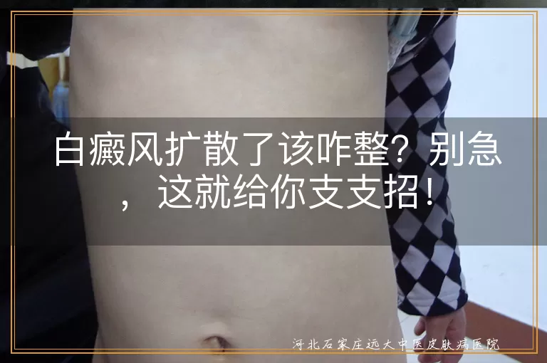 白癜风扩散了该咋整？别急，这就给你支支招！