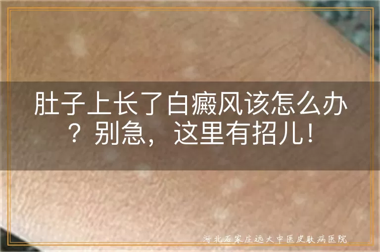 肚子上长了白癜风该怎么办？别急，这里有招儿！