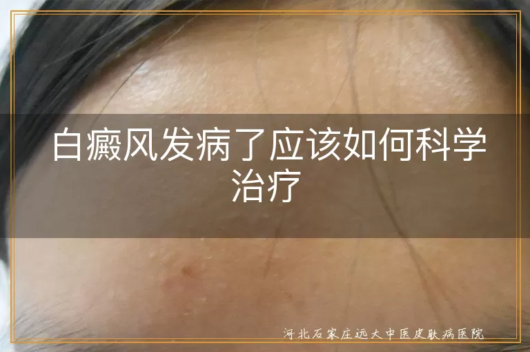 白癜风,科学治疗,专业诊断,个性化治疗方案,坚持治疗,生活调理,辅助治疗,注意事项