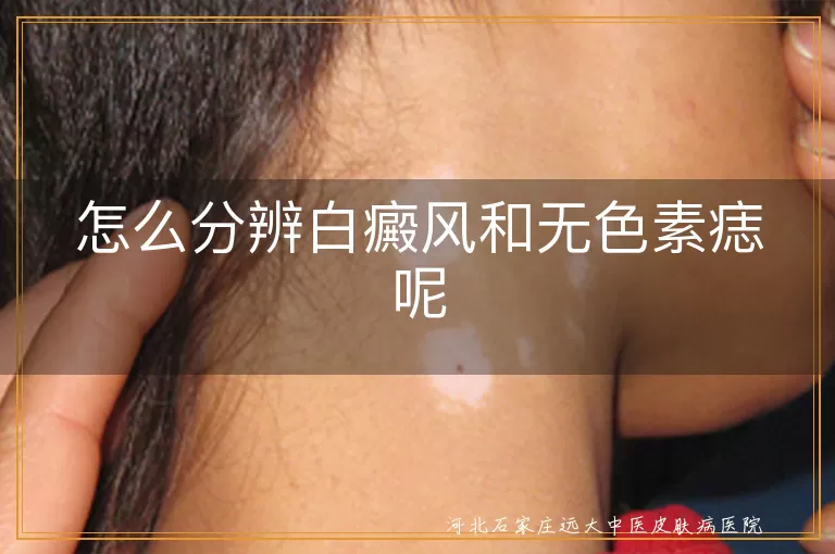 白癜风,无色素痣,色素脱失,黑色素细胞,白斑,治疗方法