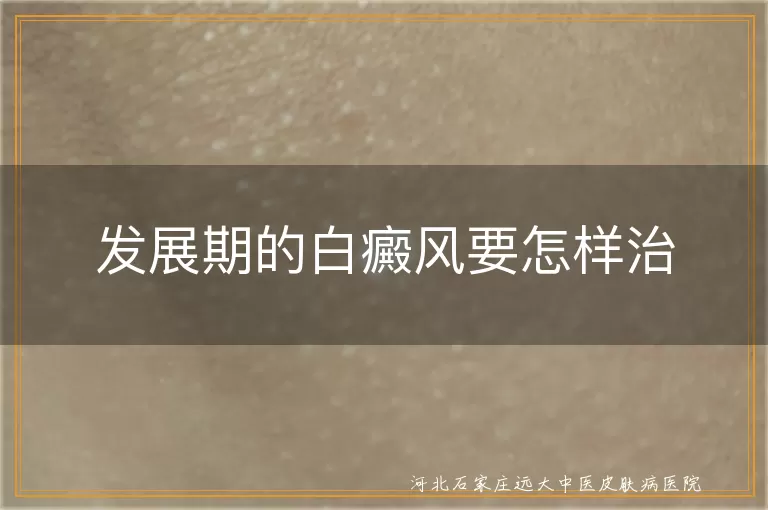 发展期白癜风,治疗,药物,光疗,激光治疗,生活调理,误区,及时就医,规范治疗