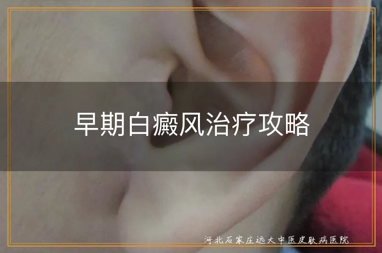 早期白癜风治疗攻略