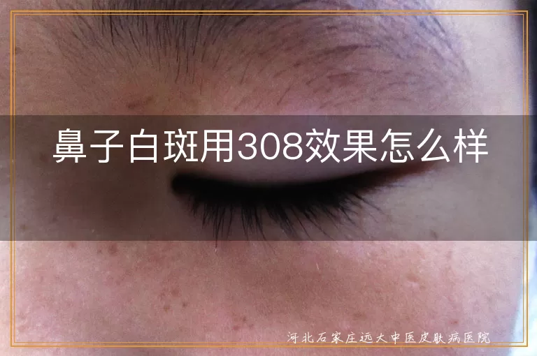 鼻子白斑用308效果怎么样