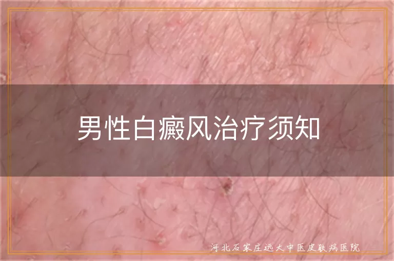 男性白癜风治疗须知