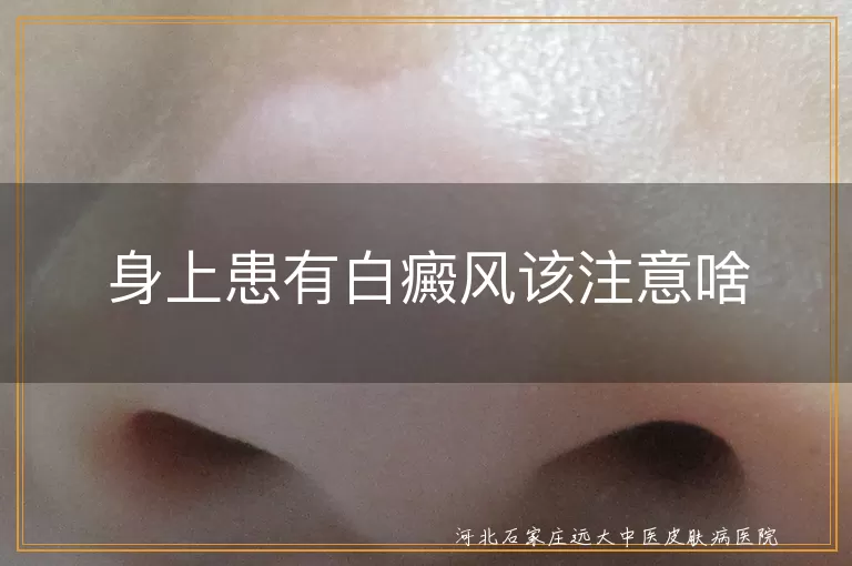 身上患有白癜风该注意啥