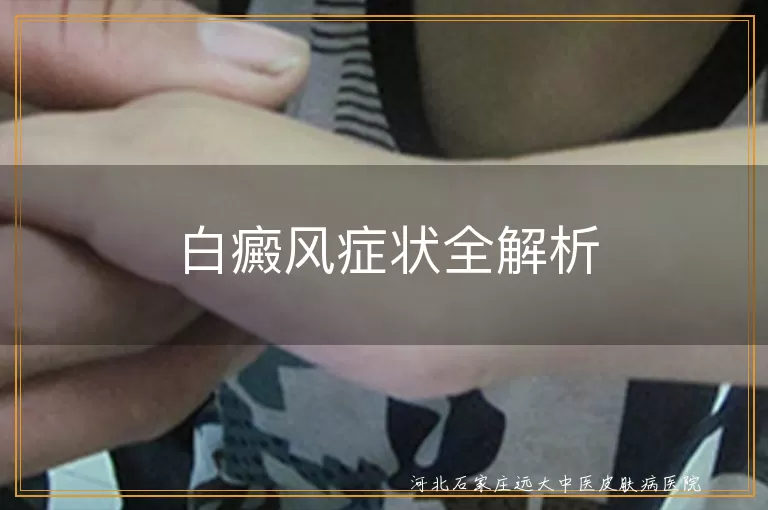 白癜风症状全解析