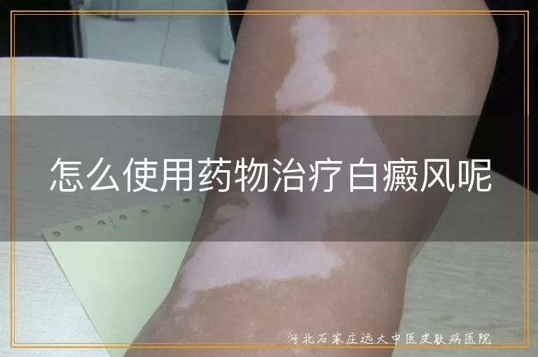 怎么使用药物治疗白癜风呢
