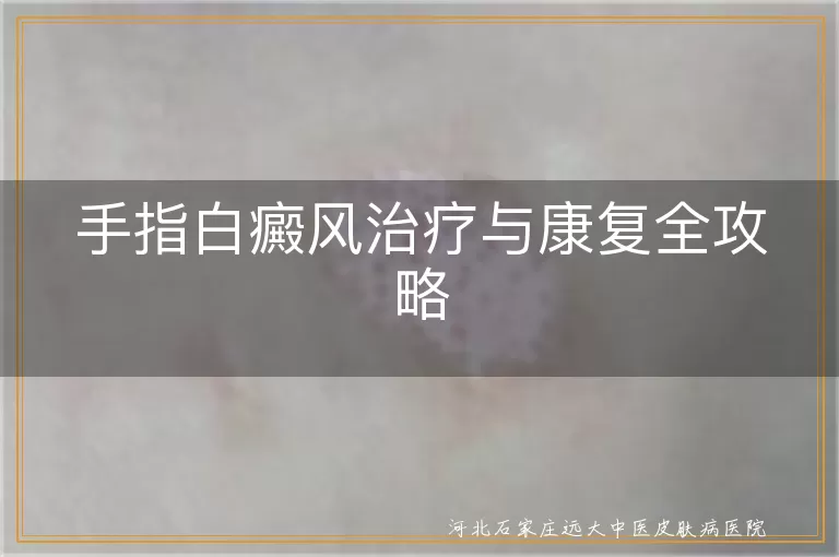 手指白癜风治疗方法,白斑康复指南,白癜风饮食调整,白癜风心情调节