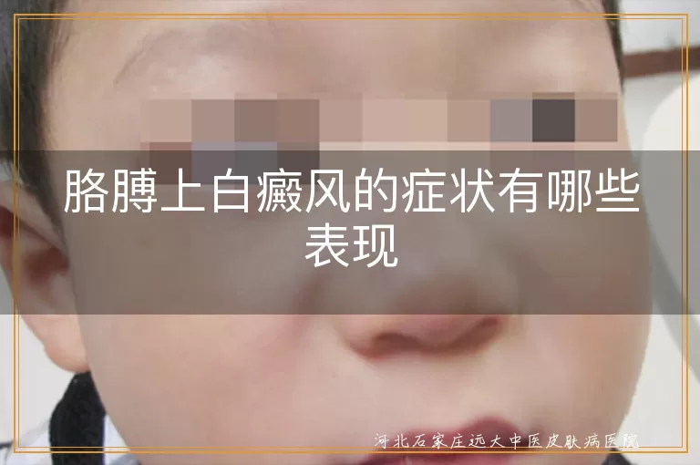 胳膊上白癜风的症状有哪些表现