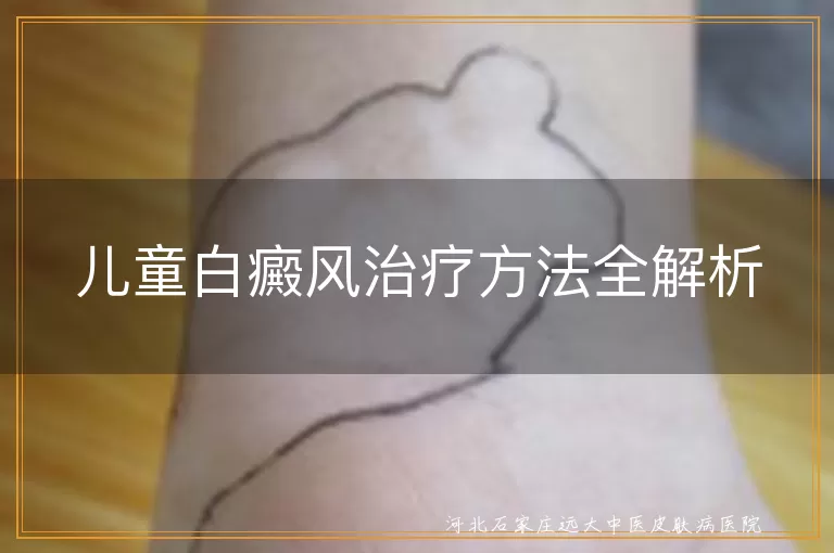 儿童白癜风治疗方法全解析