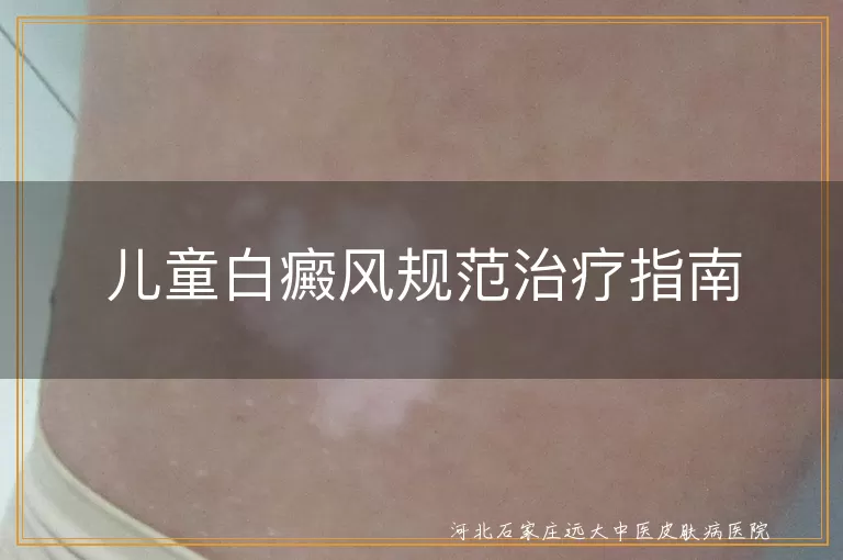 儿童白癜风规范治疗指南