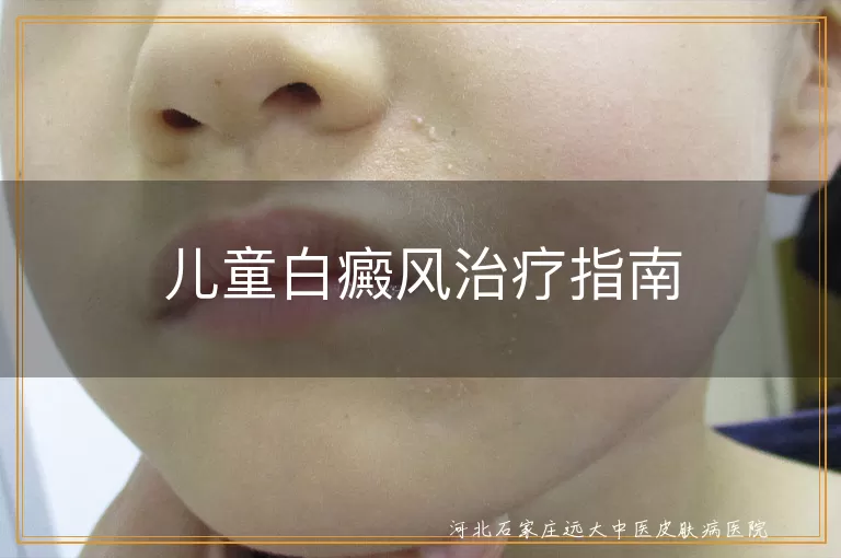 儿童白癜风治疗指南