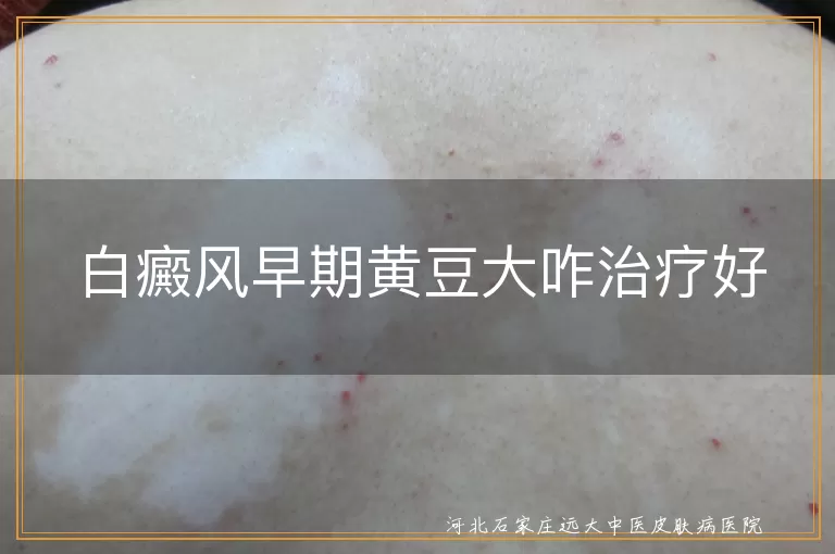 白癜风早期黄豆大咋治疗好