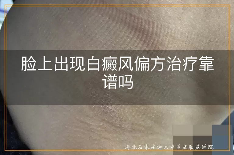 脸上出现白癜风偏方治疗靠谱吗