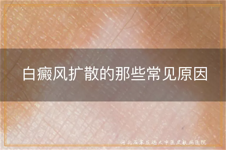 白癜风扩散的那些常见原因