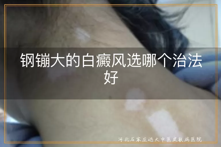 钢镚大的白癜风选哪个治法好