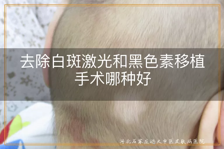 去除白斑激光和黑色素移植手术哪种好
