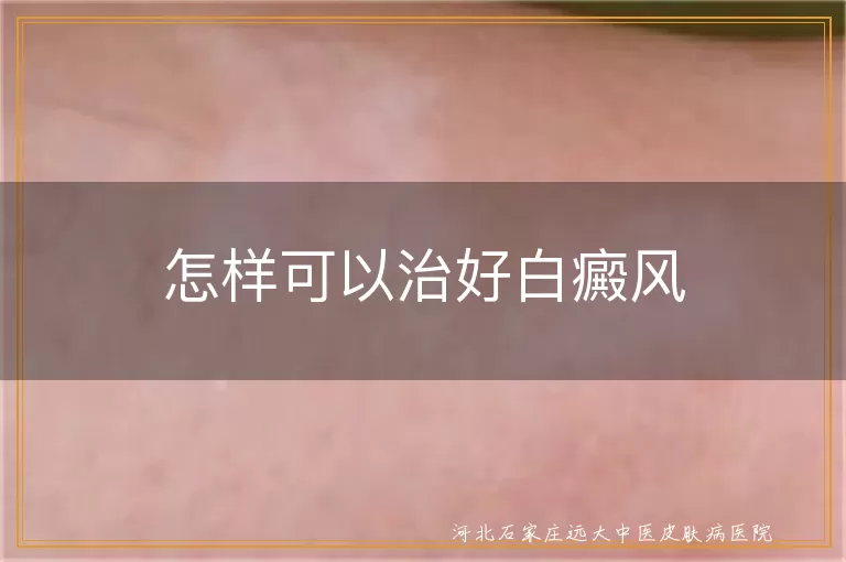 怎样可以治好白癜风
