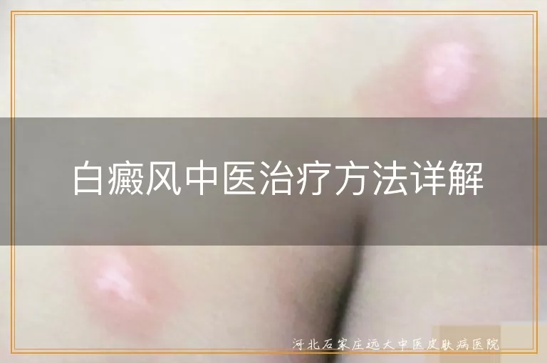 白癜风中医治疗方法详解