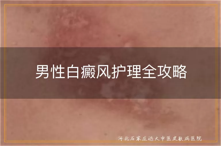 男性白癜风护理全攻略