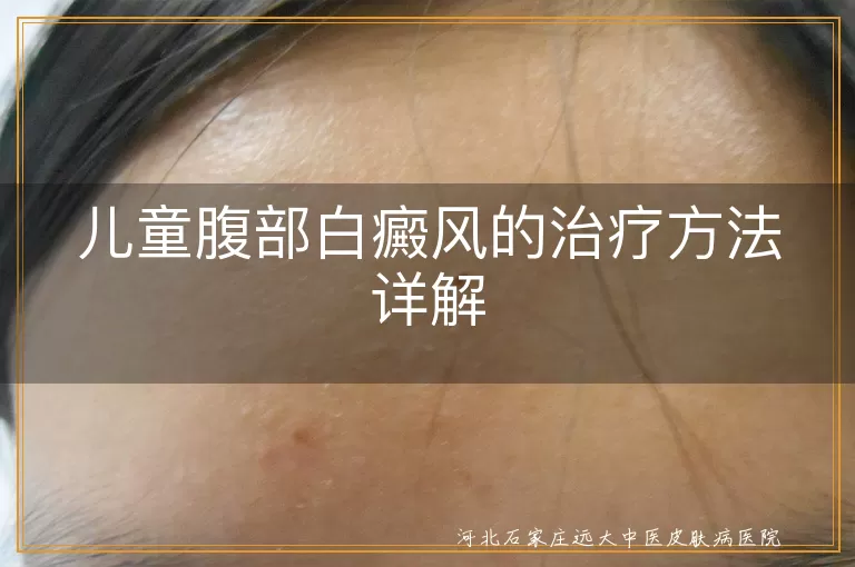 儿童白癜风治疗方法, 腹部白斑治疗详解, 白癜风药物与光疗, 儿童白斑综合疗法