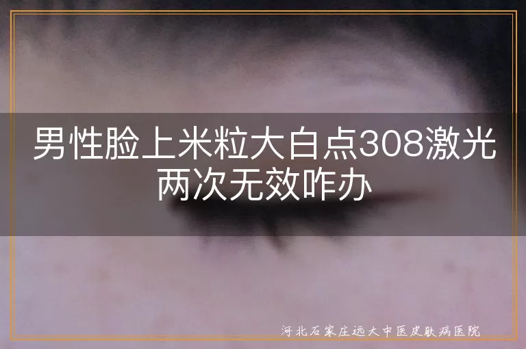 男性脸上米粒大白点308激光两次无效咋办