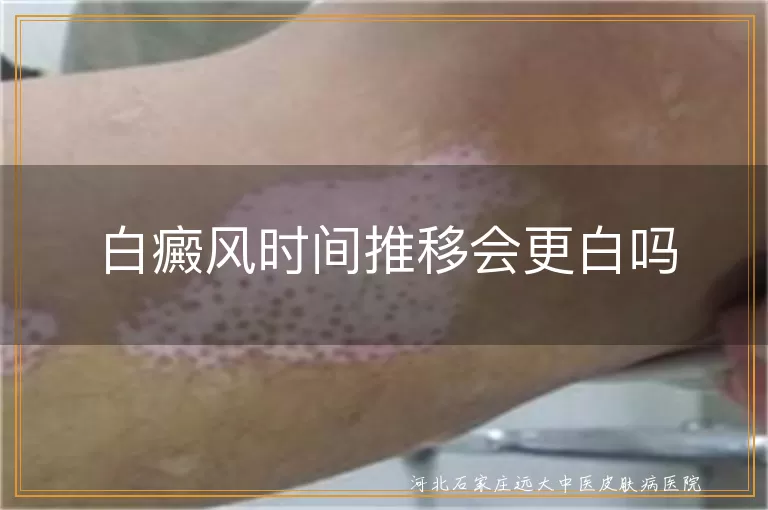 白癜风时间推移会更白吗