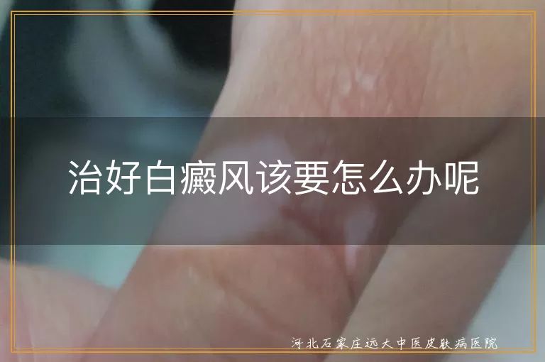 治好白癜风该要怎么办呢