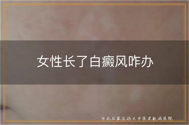 女性长了白癜风咋办