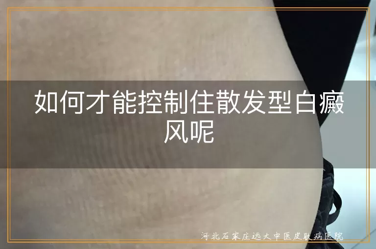 如何才能控制住散发型白癜风呢
