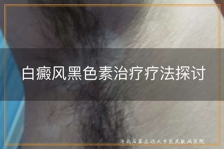 白癜风黑色素治疗疗法探讨