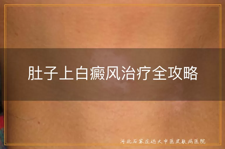 肚子上白癜风治疗全攻略