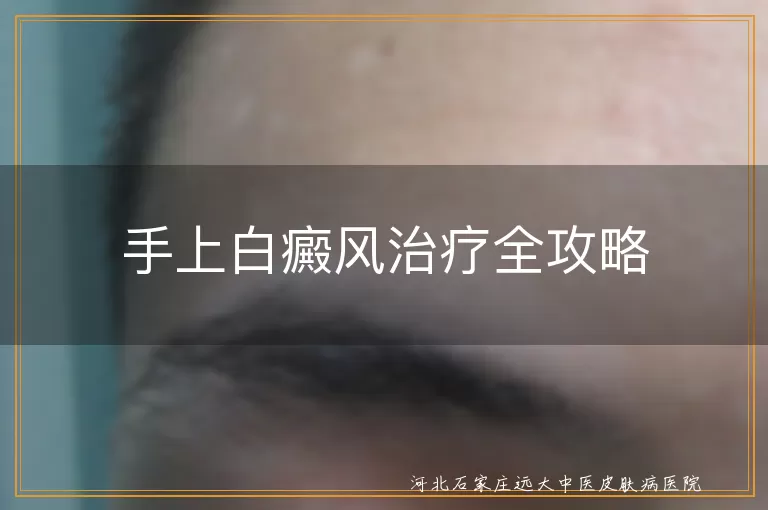 手上白癜风治疗全攻略