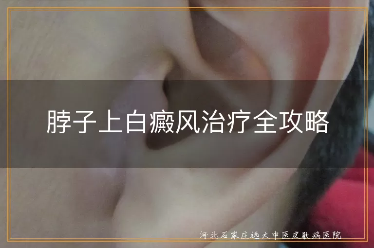 脖子上白癜风治疗全攻略
