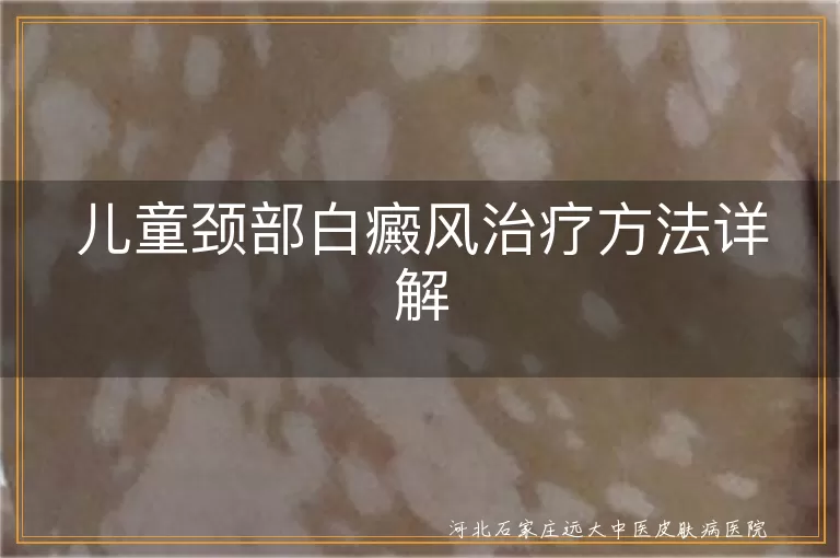 儿童颈部白癜风治疗方法详解