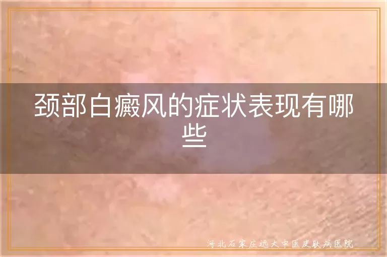 颈部白癜风的症状表现有哪些